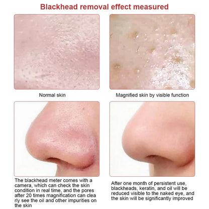 Visible Camera Blackhead Remover Vacuum Suction